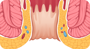 Hämorrhoiden illustration (Mobile)