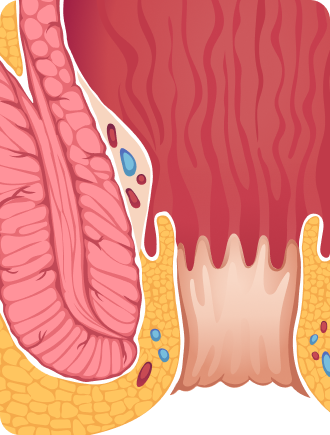 Hämorrhoiden illustration (Desktop)